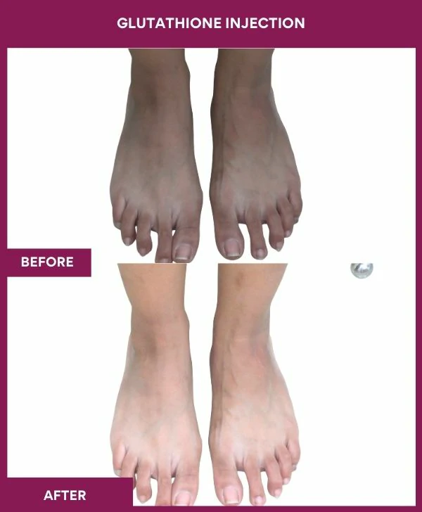 glutathione-injection-before-after-results-mumbai-india-patient21-leg