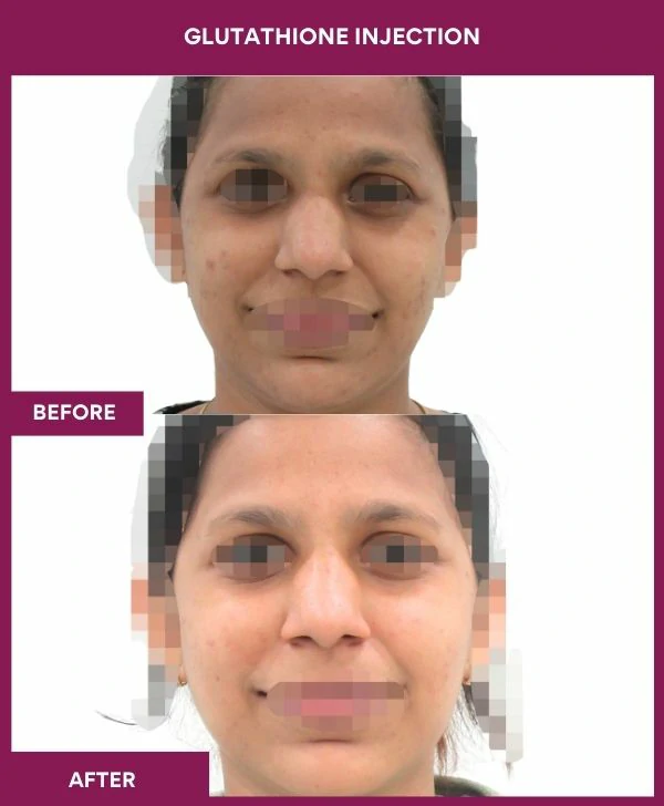 glutathione-injection-before-after-results-mumbai-india-patient22-face