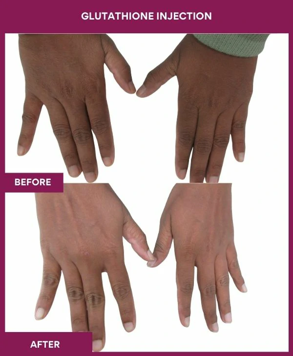 glutathione-injection-before-after-results-mumbai-india-patient22-hand