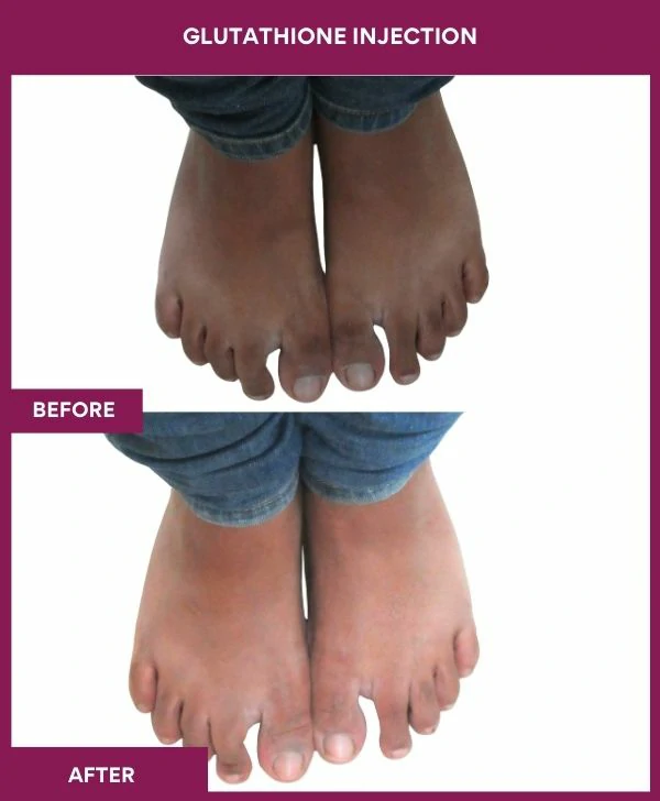 glutathione-injection-before-after-results-mumbai--india-patient22-leg