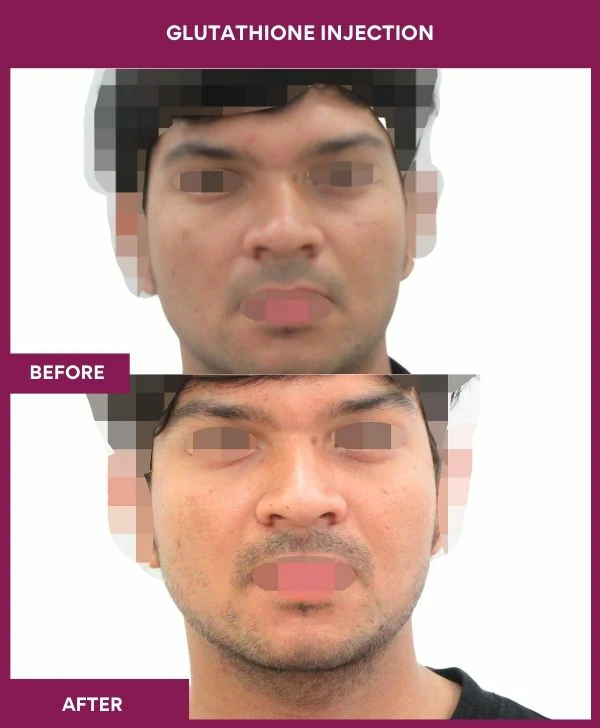 glutathione-injection-before-after-results-mumbai-india-patient23-face