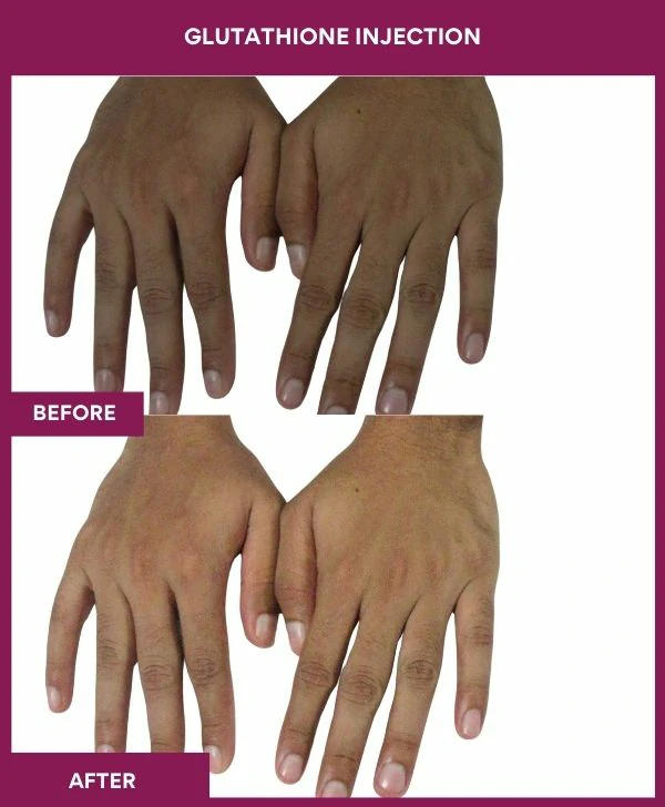 glutathione-injection-before-after-results-mumbai-india-patient23-hand