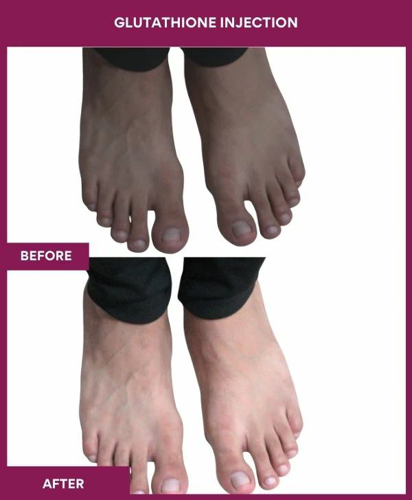 glutathione-injection-before-after-results-mumbai-india-patient23-leg