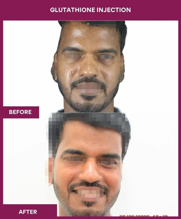 glutathione-injection-before-after-results-mumbai-india-patient24-face