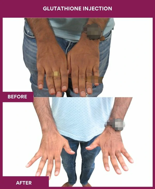 glutathione-injection-before-after-results-mumbai-india-patient24-hand