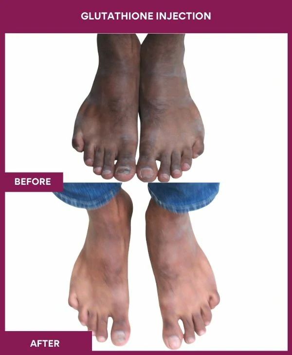 glutathione-injection-before-after-results-mumbai-india-patient24-leg