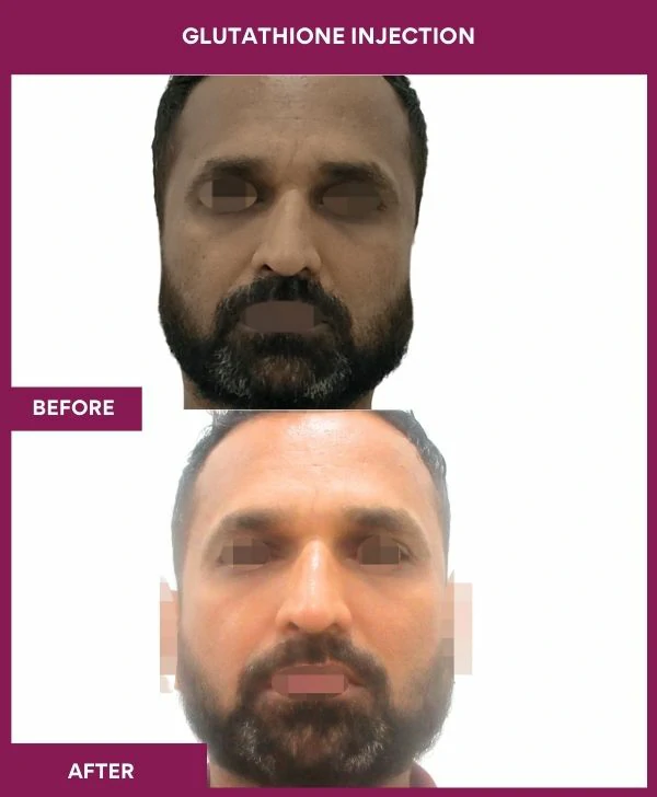 glutathione-injection-before-after-results-mumbai-india-patient25-face