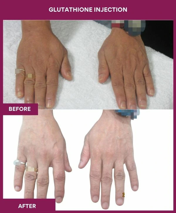 glutathione-injection-before-after-results-mumbai-india-patient25-hand