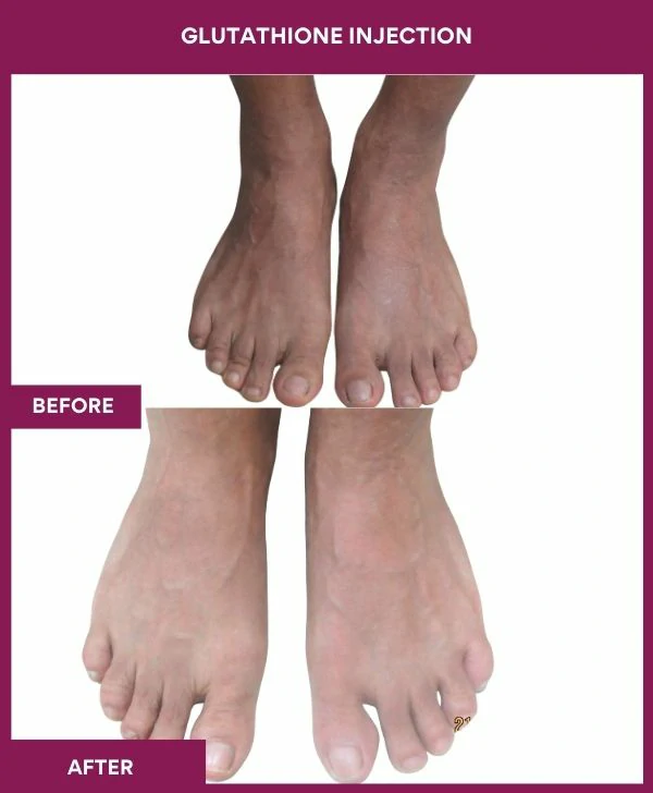 glutathione-injection-before-after-results-mumbai-india-patient25-leg