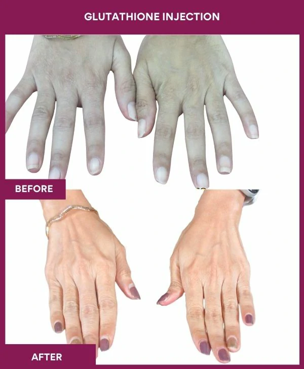 glutathione-injection-before-after-results-mumbai-india-patient26-hand