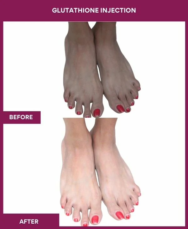 glutathione-injection-before-after-results-mumbai-india-patient26-leg