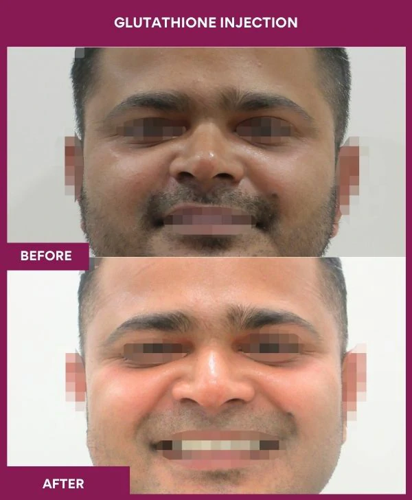 glutathione-injection-before-after-results-mumbai-patient27-face