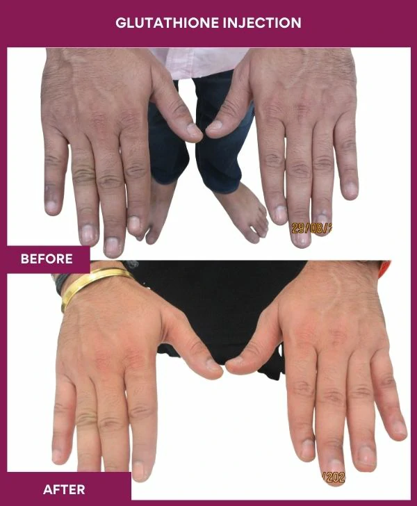 glutathione-injection-before-after-results-mumbai-india-patient27-hand