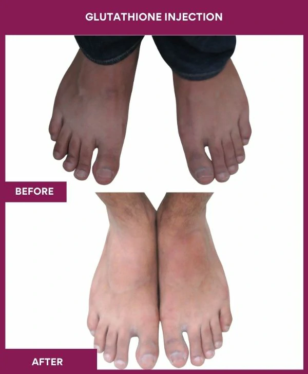 glutathione-injection-before-after-results-mumbai-india-patient27-leg