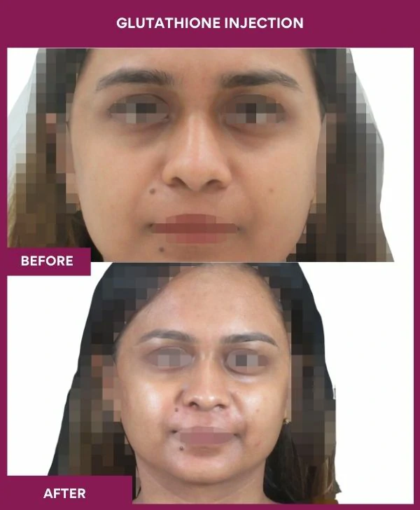 glutathione-injection-before-after-results-mumbai-india-patient28-face