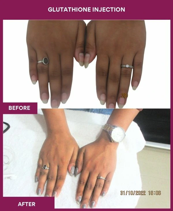 glutathione-injection-before-after-results-mumbai-india-patient28-hand