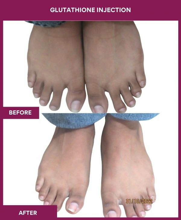glutathione-injection-before-after-results-mumbai-india-patient28-leg