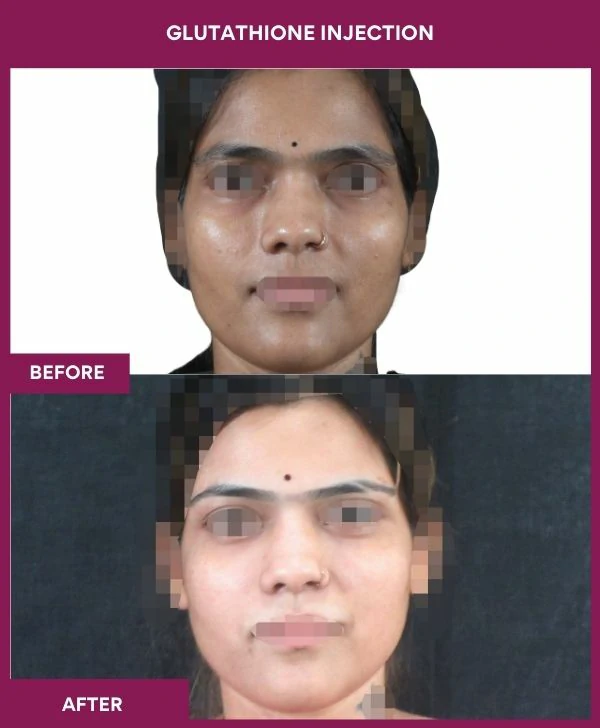 glutathione-injection-before-after-results-mumbai-india-patient29-face
