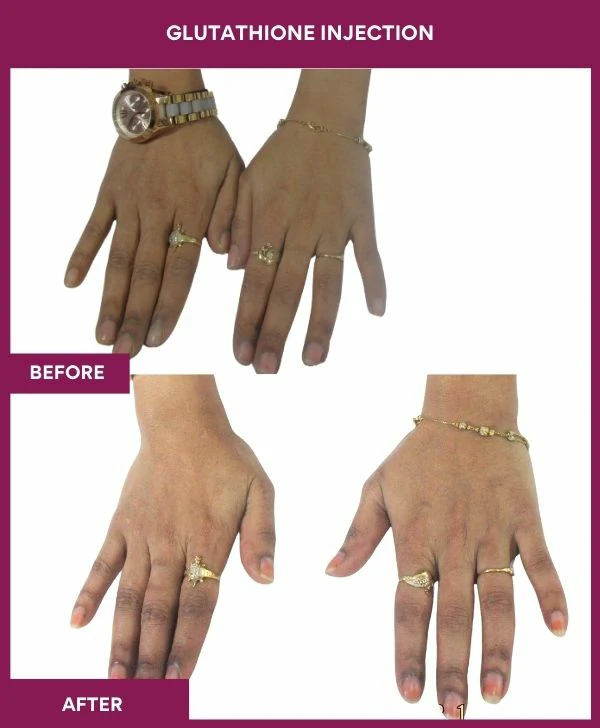 glutathione-injection-before-after-results-mumbai-india-patient29-hand