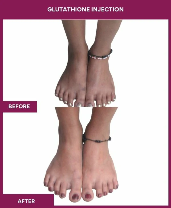 glutathione-injection-before-after-results-mumbai-india-patient29-leg