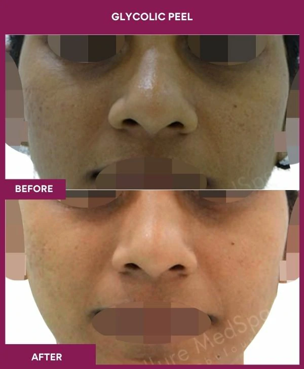 glycolic-peel-treatment-before-after-results-mumbai-india-patient01-front