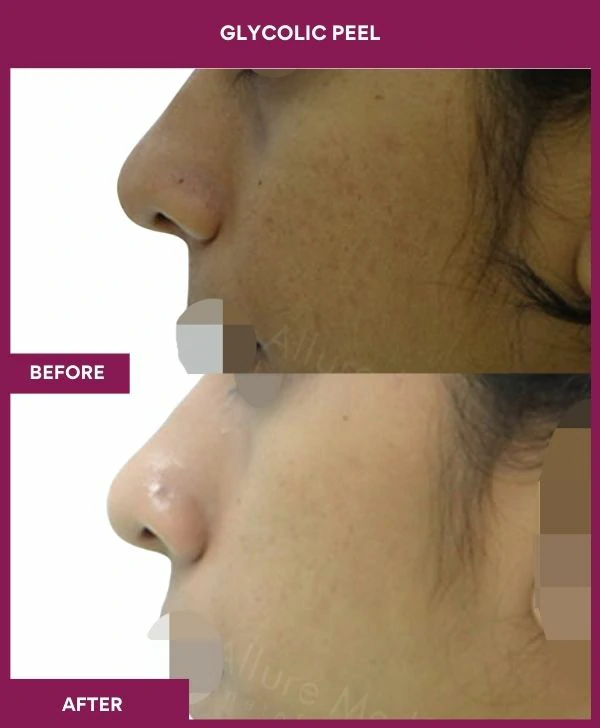 glycolic-peel-treatment-before-after-results-mumbai-india-patient01-side-left