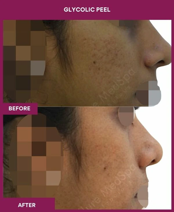 glycolic-peel-treatment-before-after-results-mumbai-india-patient01-side-right