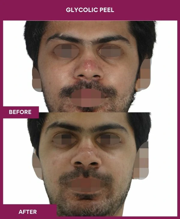 glycolic-peel-treatment-before-after-results-mumbai-india-patient02-front