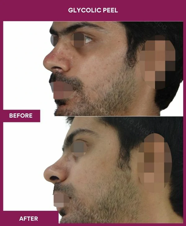 glycolic-peel-treatment-before-after-results-mumbai-india-patient02-side-left