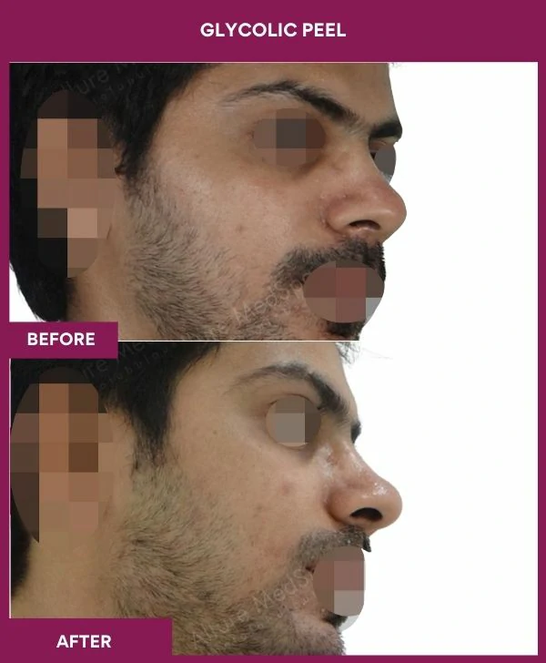 glycolic-peel-treatment-before-after-results-mumbai-india-patient02-side-right