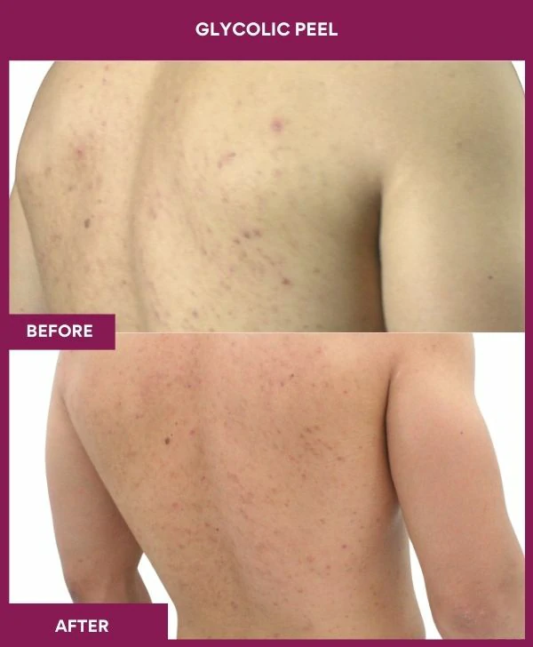 glycolic-peel-treatment-before-after-results-mumbai-india-patient03-Back left