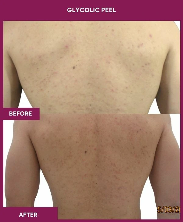 glycolic-peel-treatment-before-after-results-mumbai-india-patient03-back-front