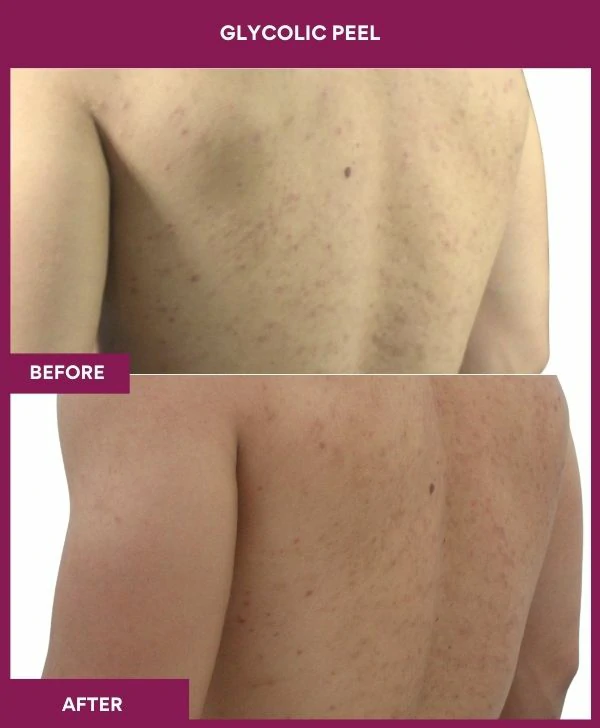 glycolic-peel-treatment-before-after-results-mumbai-india-patient03-back-right