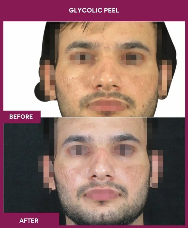 glycolic-peel-treatment-before-after-results-mumbai-india-patient04-front