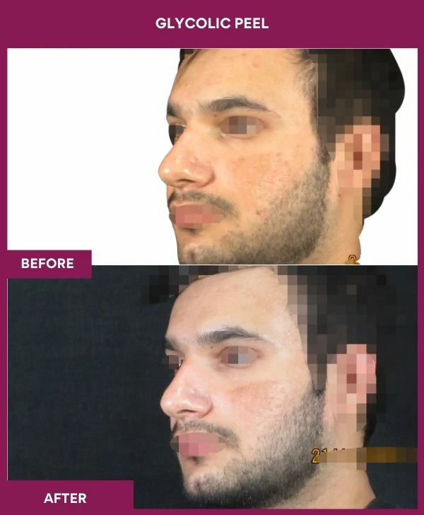 glycolic-peel-treatment-before-after-results-mumbai-india-patient04-side-left