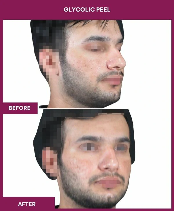 glycolic-peel-treatment-before-after-results-mumbai-india-patient04-side-right