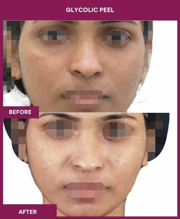glycolic-peel-treatment-before-after-results-mumbai-india-patient05-front