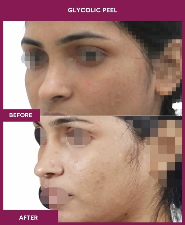 glycolic-peel-treatment-before-after-results-mumbai-india-patient05-side-left