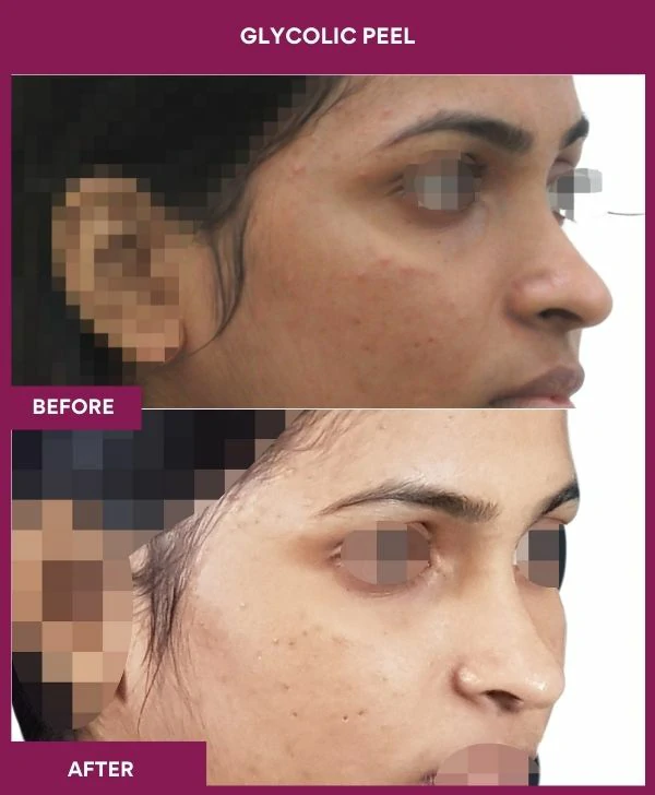 glycolic-peel-treatment-before-after-results-mumbai-india-patient05-side-right