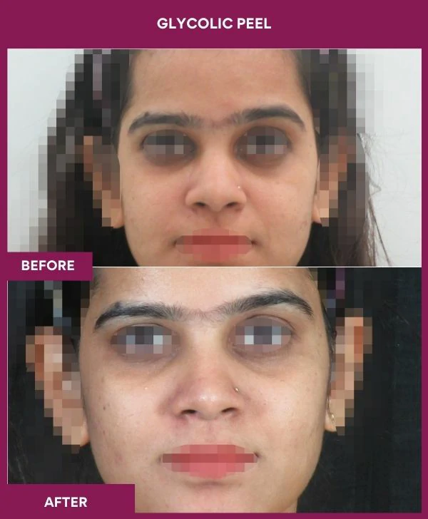 glycolic-peel-treatment-before-after-results-mumbai-india-patient06-front