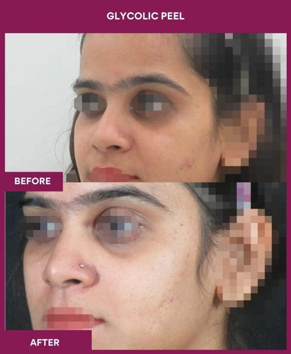 glycolic-peel-treatment-before-after-results-mumbai-india-patient06-side-left
