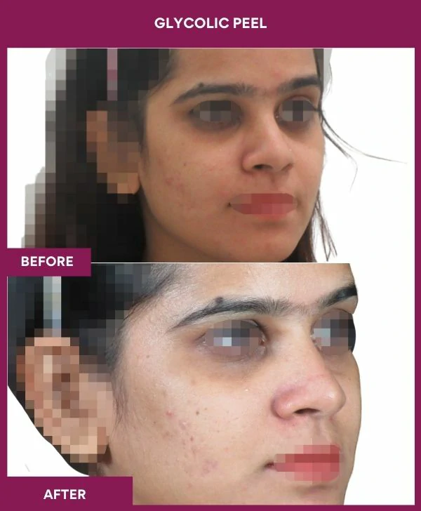 glycolic-peel-treatment-before-after-results-mumbai-india-patient06-side-right