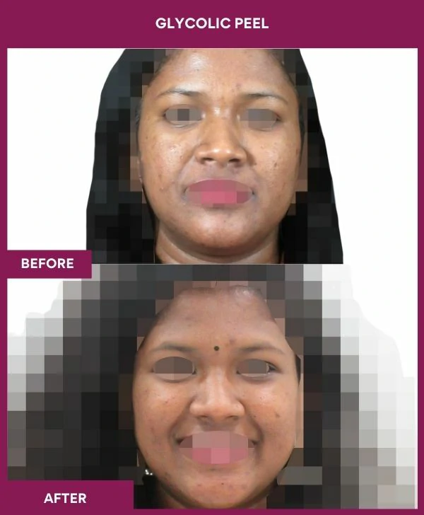 glycolic-peel-treatment-before-after-results-mumbai-india-patient07-front