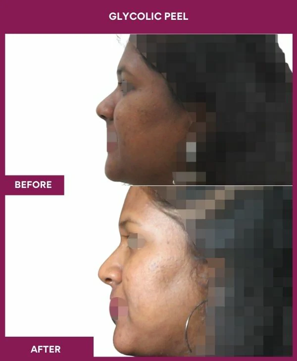 glycolic-peel-treatment-before-after-results-mumbai-india-patient07-side-left