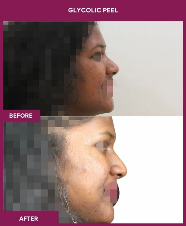 glycolic-peel-treatment-before-after-results-mumbai-india-patient07-side-right