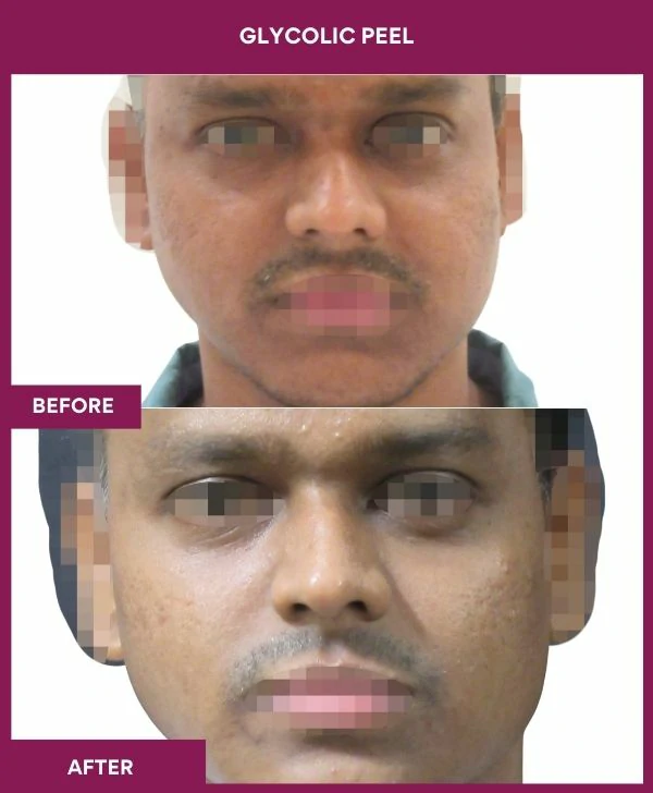 glycolic-peel-treatment-before-after-results-mumbai-india-patient08-front