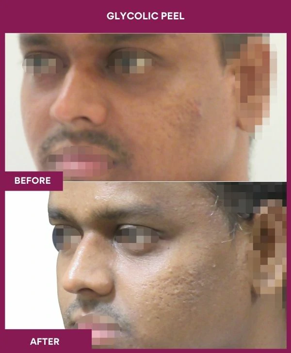 glycolic-peel-treatment-before-after-results-mumbai-india-patient08-side-left