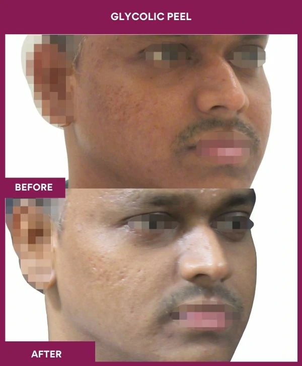 glycolic-peel-treatment-before-after-results-mumbai-india-patient08-side-right
