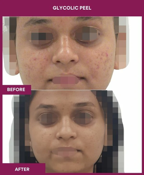 glycolic-peel-treatment-before-after-results-mumbai-india-patient09-front