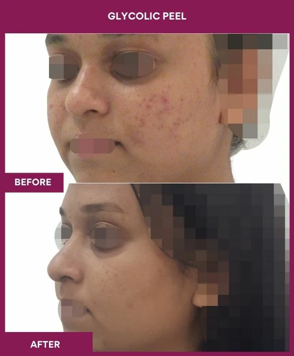 glycolic-peel-treatment-before-after-results-mumbai-india-patient09-side-left